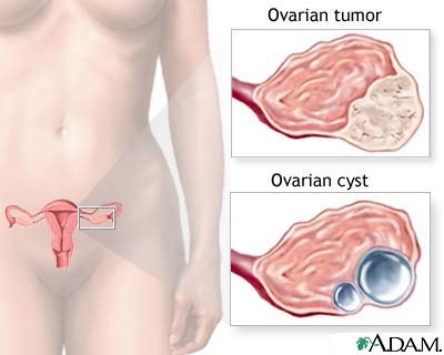 Cancerul ovarian si uterin